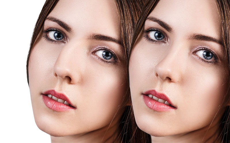 What You Dont Know About a Rhinoplasty
