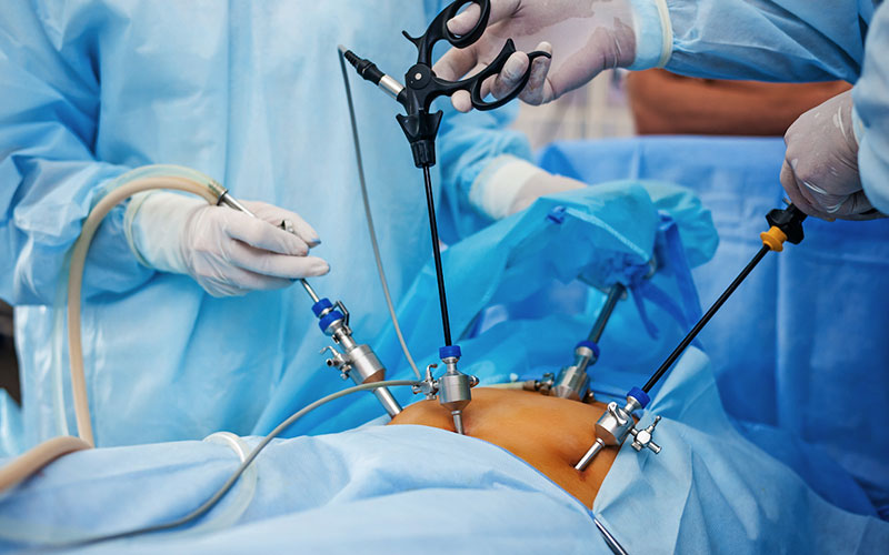Whats Laparoscopy What Are Its Benefits