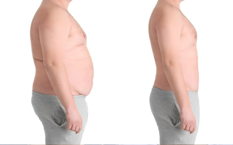 Bariatric Surgery Scars - CER Bariatrics Tijuana