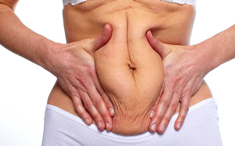 Plastic Options To Consider After Massive Weight Loss