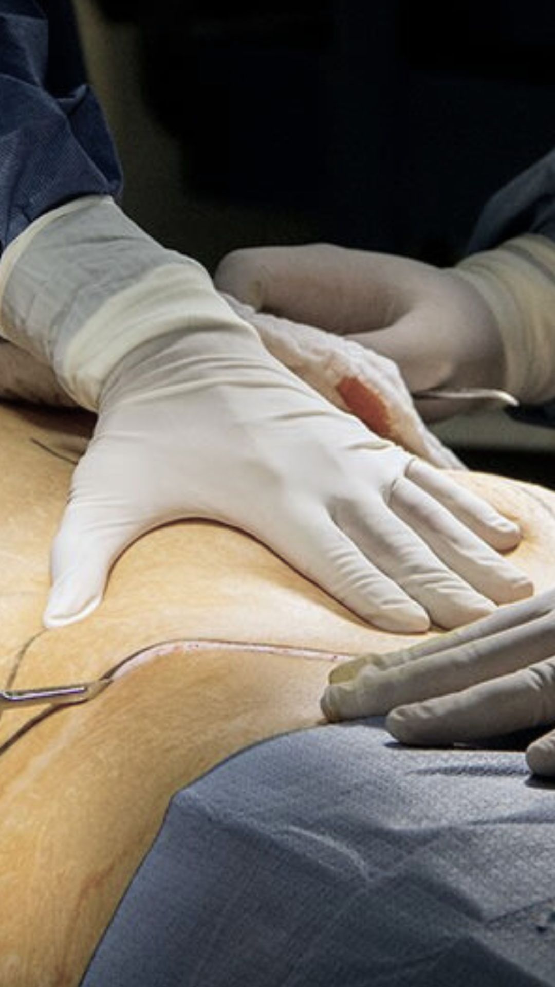 Close-up of a surgeon’s hand performing plastic surgery at CER Hospital.