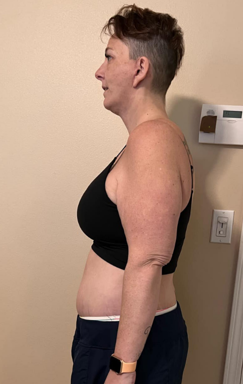 After gastric sleeve at CER Hospital in Tijuana – Patient 1 results.