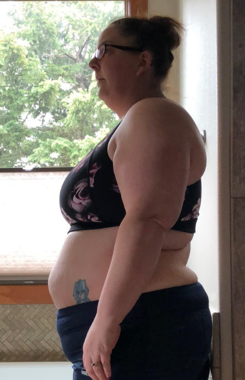 Before gastric sleeve at CER Hospital in Tijuana – Patient 1 transformation.