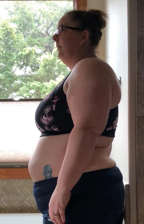Before gastric sleeve at CER Hospital in Tijuana – Patient 1 transformation.
